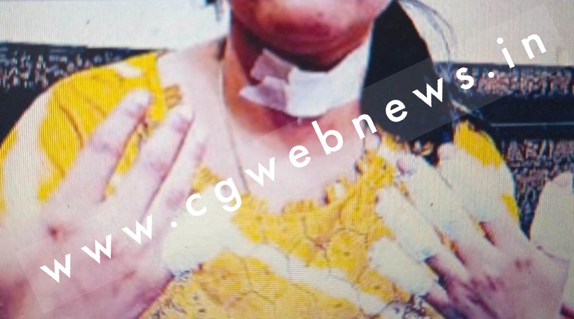 छत्तीसगढ़ - चायनीज मांझे से कटा युवती का गला , बाल बाल बची जान , एमपी में सरकार लगा चुकी है प्रतिबंध