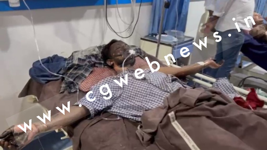 छत्तीसगढ़ - स्टील प्लांट में बड़ा हादसा , प्लांट के टैंक में ब्लास्ट होने से 06 मजदूर गंभीर रूप से झुलसे