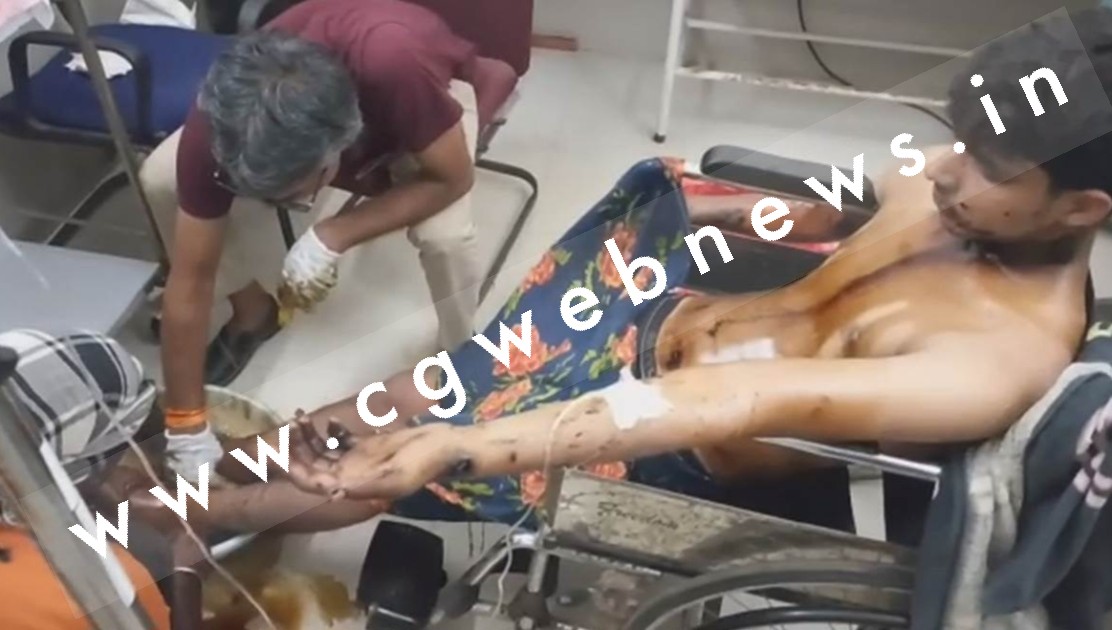 छत्तीसगढ़ - डामर प्लांट में हादसा , डामर खाली करते वक्त मजदूर झुलसा