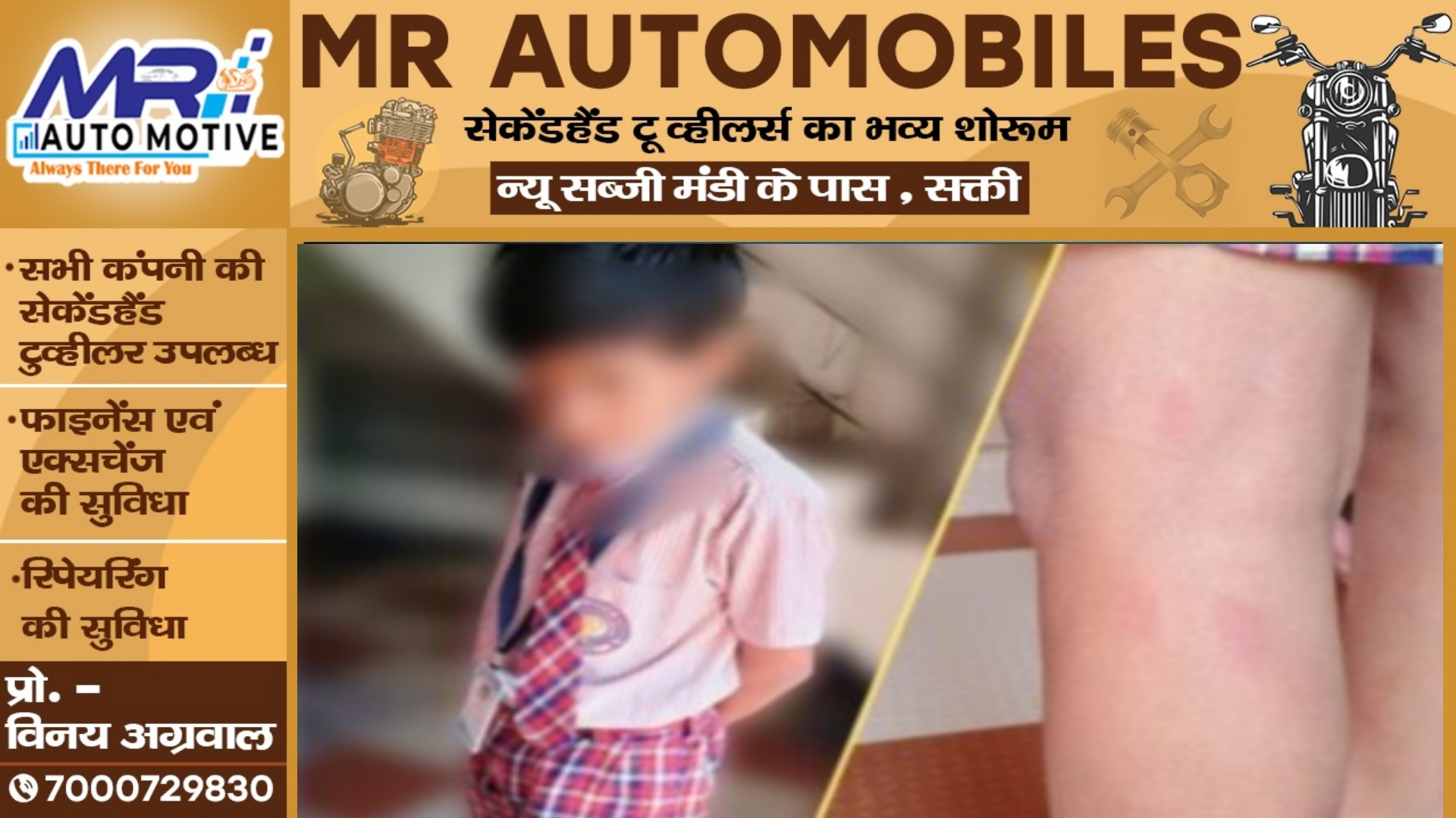 छत्तीसगढ़ - अग्रसेन पब्लिक स्कूल की क्रूर शिक्षिका , गुस्से में आकर 05वी के छात्र को दी ऐसी सजा की,,,